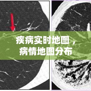 疾病实时地图 ，病情地图分布