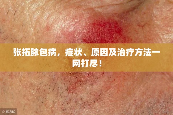 张拓脓包病，症状、原因及治疗方法一网打尽！